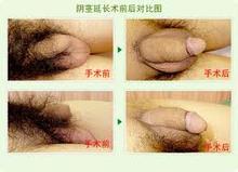 锦州阴茎延长术什么费用