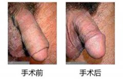 锦州做包皮手术要多少