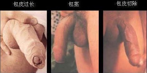 包皮手术锦州哪家最好